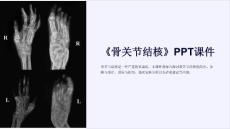 《骨关节结核》课件