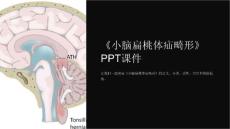 《小脑扁桃体疝畸形》课件
