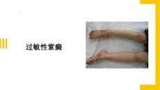 过敏性紫癜