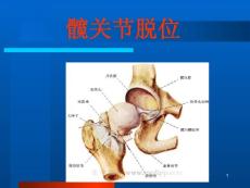 髋关节脱位课件