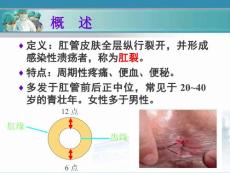 肛裂教学.ppt