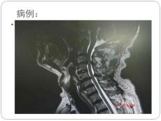 颈椎病康复