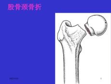股骨颈骨折