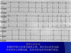 短阵心房扑动.ppt