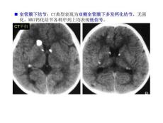 结节性硬化症ppt课件.ppt
