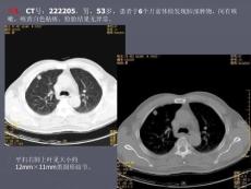 肺类癌何亚奇课件