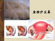 子宫内膜异位症