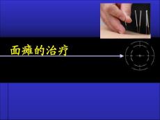 面瘫治疗详解