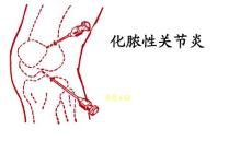 化脓性关节炎
