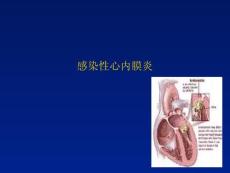 感染心内膜炎-课件