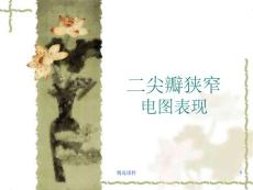 二尖瓣狭窄心电图表现