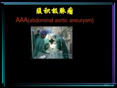 腹主动脉瘤讲解培训课件