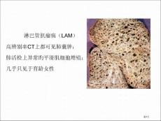 淋巴管肌瘤病的肺部CT表现