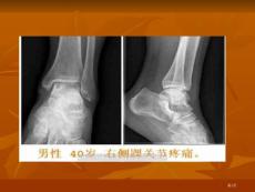 骨内腱鞘囊肿影像表现
