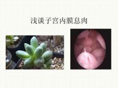子宫内膜息肉PPT培训课件
