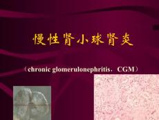 慢性肾炎隐匿肾炎PPT培训课件