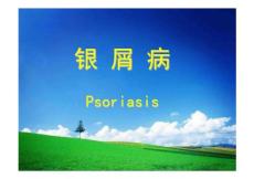 银屑病的诊疗