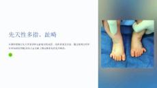 《先天性多指、趾畸》课件