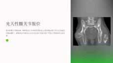 《先天性髋关节脱位》课件