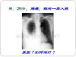 胸腔积液课件