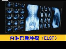 韦格纳肉芽肿.ppt