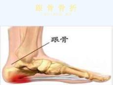 跟骨骨折护理