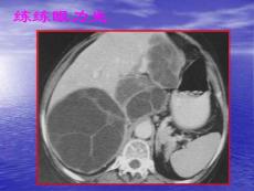 肝包虫病.ppt