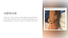 《动静脉内瘘》课件