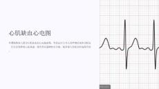 《心肌缺血心电图》课件