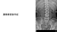 《腰椎椎管狭窄症》课件