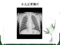 小儿肺炎胸片