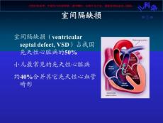 先天性心脏病VSdtofPDA