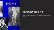 《脊柱结核》课件