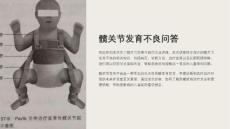 《髋关节发育不良问答》课件