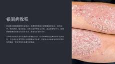 《银屑病教程》课件