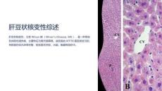 《肝豆状核变性综述》课件