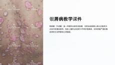 银屑病教学课件
