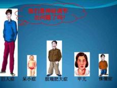 巨人症课件
