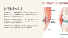 《类风湿性关节炎》课件