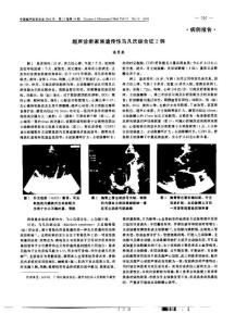 超声诊断家族遗传性马凡氏综合征2例病例报告?
