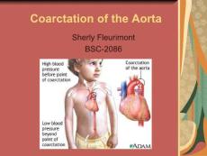 主动脉缩窄（Coarctation of the Aorta）